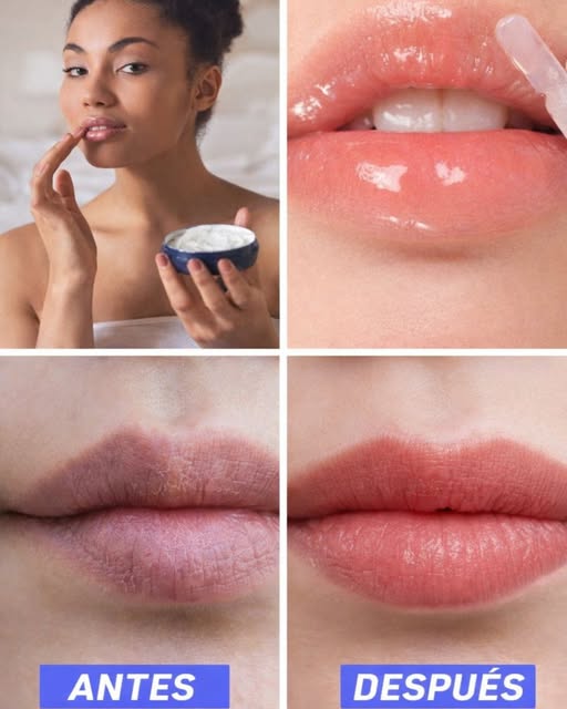 Antes y después de un tratamiento labial