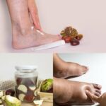 Castaño de Indias el remedio natural para piernas hinchadas y mala circulación