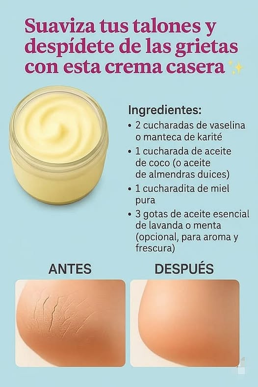 Crema Casera para Talones Agrietados